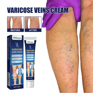 South Moon Varicose Veins Cream Obat Varises Salep Penghilang Varises Vaskulitis 20g