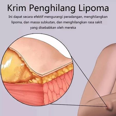 Lipoma Removal Cream Penghilang Kista & Lipoma Atasi Benjolan Lipoma Cepat Kempes Hilangkan Kista Lemak Kempes Tanpa Bedah