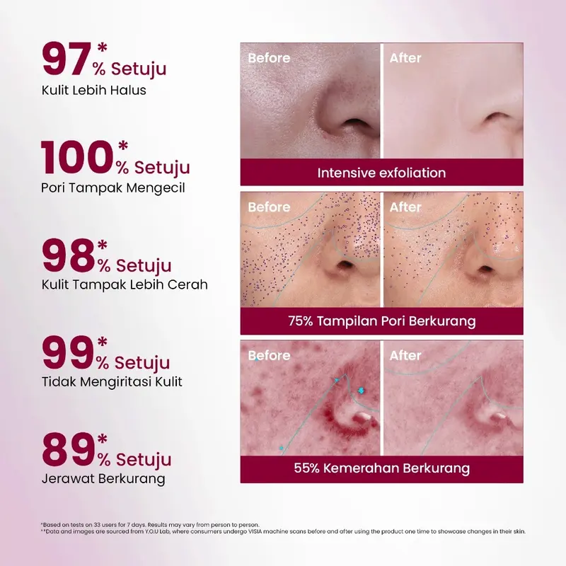 [NEW LAUNCH]  12% Acid Intensive Peeling Serum Intensive Peeling Solution Aha Bha Pha Serum Eksfoliasi Untuk Kulit Cerah Dan Halus 2