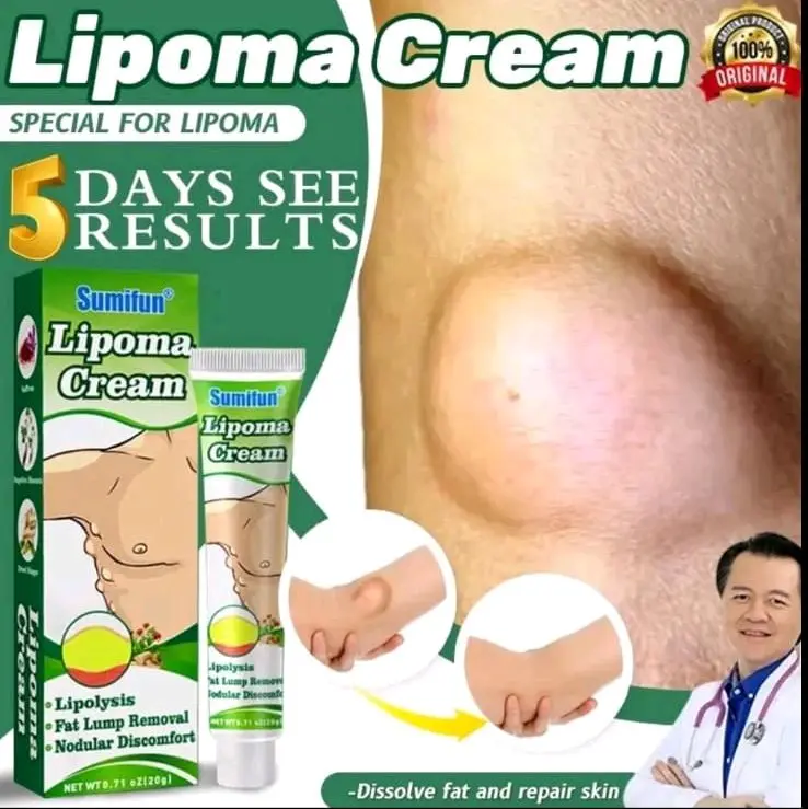 Lipoma Cream Obat Benjolan Lipoma Krim Benjolan Di Leher Tangan Ketiak Benjolan Di Leher Punggung Pundak Kaki Selangkangan Telinga