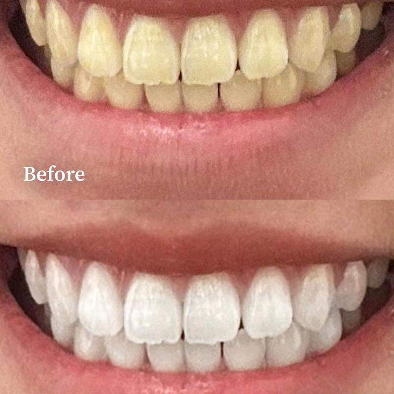 [Dhesister] Dentix Teeth Whitening Expert 3