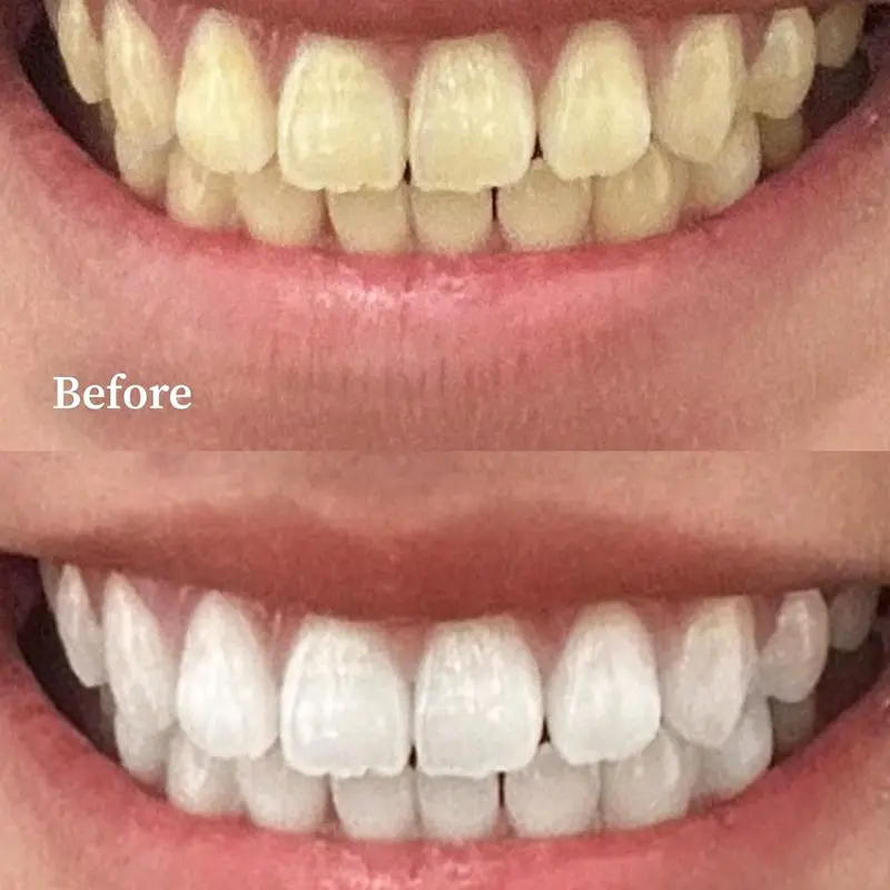 [Dhesister] Dentix Teeth Whitening Expert 3