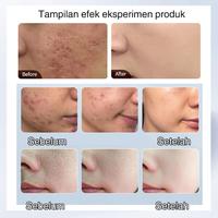 Gambar Krim Penghilang Bekas Luka & Jerawat-30g Penghilang bekas jerawat Krim wajah-Obat jerawat pemulihan bekas-Mencegah Luka Jadi Keloid & Menyamarkan Bekas Hitam - 30ML dari Sumifun Beauty Indonesia Kab. Bekasi 4 Tokopedia