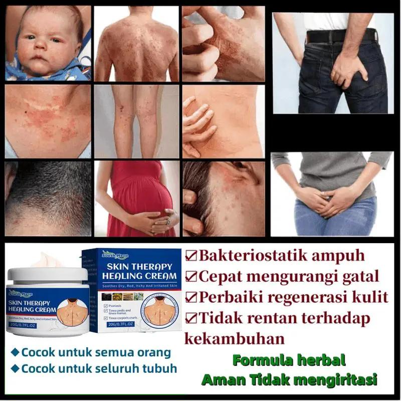 Salep gatal Salep Eksim Salep kulit Krim psoriasis paling ampuh Kulit Kepala Psoriasis Tangan Tinea Kaki Bau Versicolor Menghambat Dermatitis Jamur Anti Gatal Cream 20G