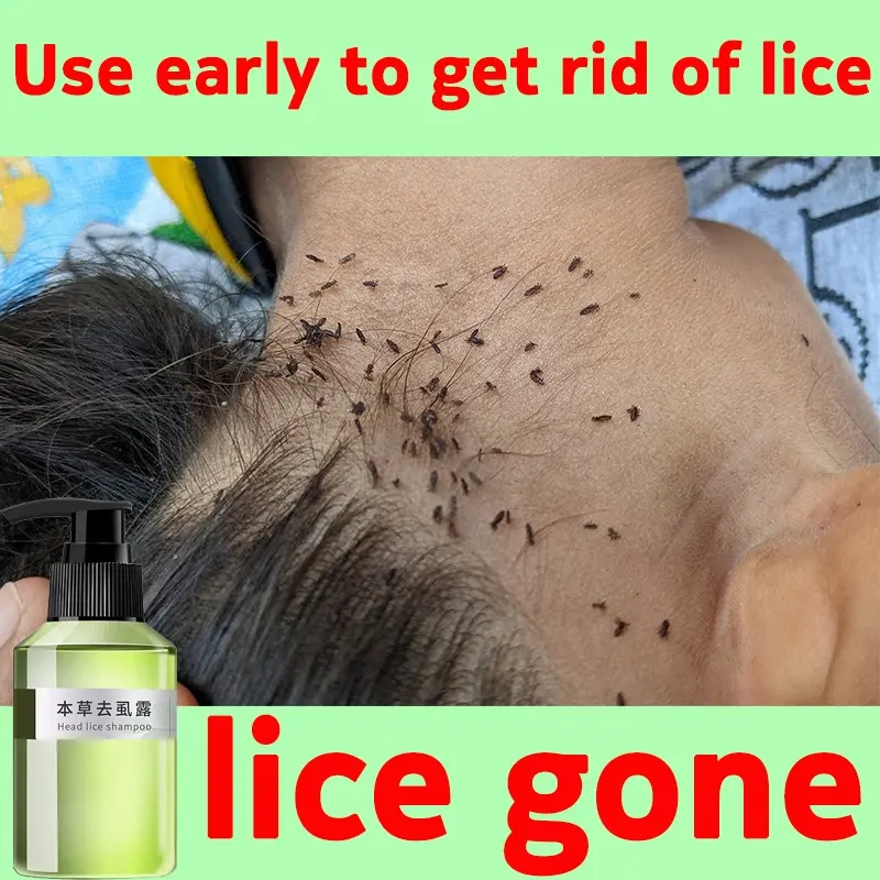 100mL lice remover shampoo Licealiz Head Lice Treatment Shampoo treatment lice remover shampoo Conditioner Haircare Plant Cleansing Moisturize Foam