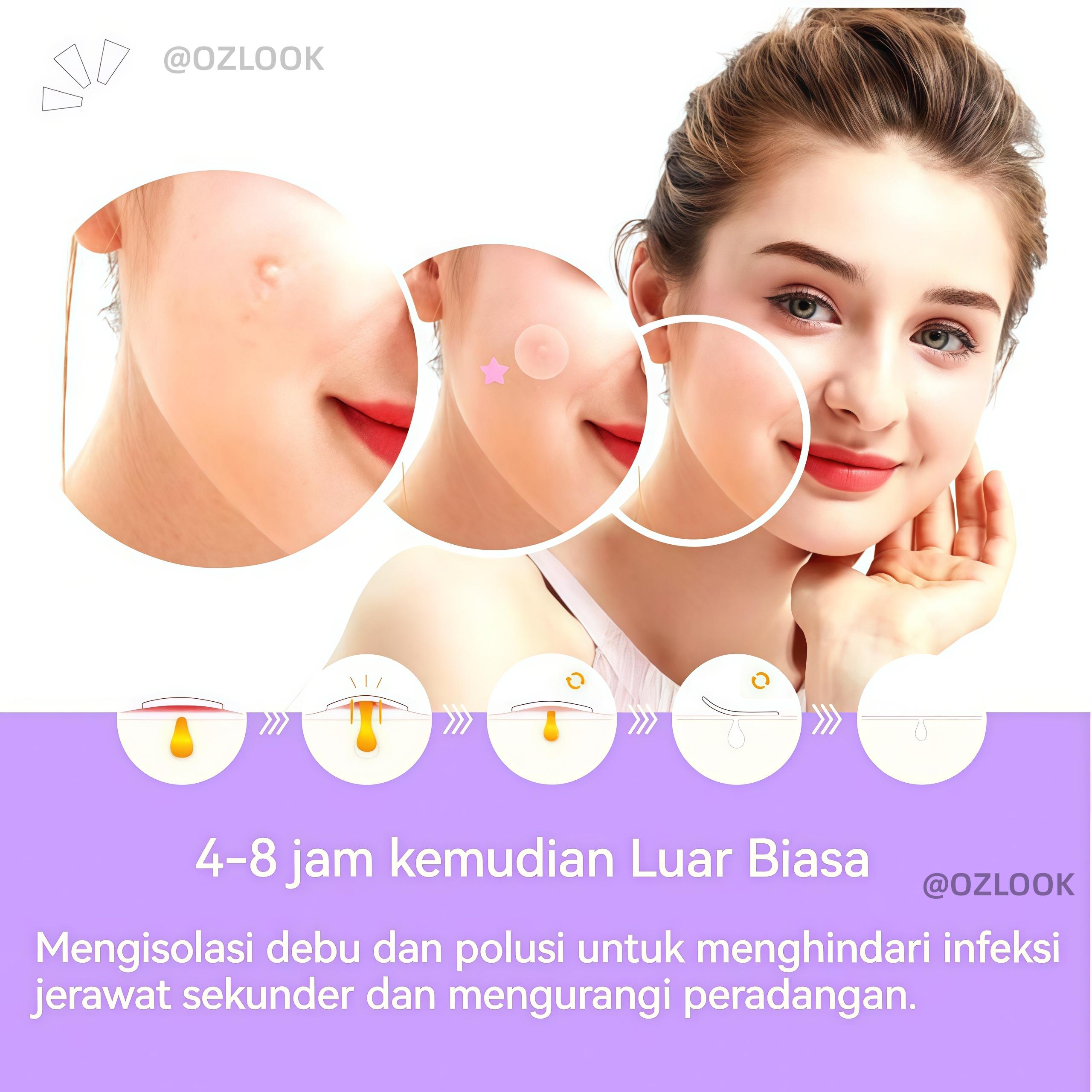 Jerawat Karakter Lucu Isi 160 Pcs Acne Pimple Patch Mengobati Mengangkat Isi Jerawat Dengan Desain Bintang Warna-warni