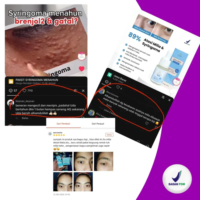 PAKET KHUSUS MILIA SYRINGOMA !! Paket 2in1 milia syringoma Cream & serum yang di formulasikan khusus untuk mengatasi milia serum cream Leika Skincare 3