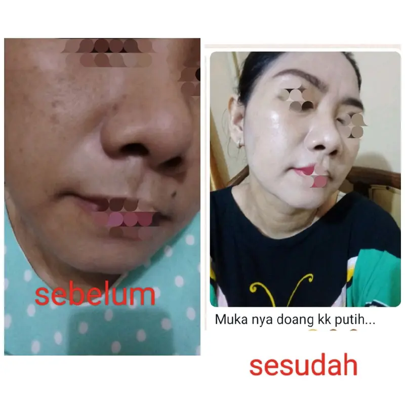 paket whitening kulit sensitif 5