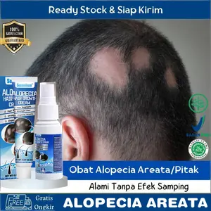 Obat Pitak Obat Alopecia Areata, Obat Penumbuh Rambut Botak, Obat Botak Koin, Obat Rambut Pitak, Obat Penghilang Botak Koin, Obat Penumbuh Rambut Pitak, Obat Penumbuh Rambut Botak Dengan