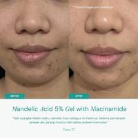 Gambar FOR SKIN'S SAKE FSS MANDELIC ACID GEL 5% WITH NIACINAMIDE 100ML Hyaluronic Wajah Essence Vitamin dari VitaminDiskon Kota Administrasi Jakarta Utara 5 Tokopedia