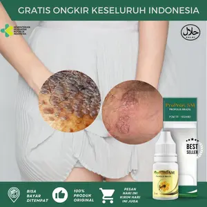 Propolis SM Penghilang Kutil HPV Untuk Wanita dan Pria, Menghilangkan Gatal Pada Kelamin/Kemaluan, Kutil Seperti Jengger Ayam, Benjolan Jerawat di Miss V, Infeksi Jamur