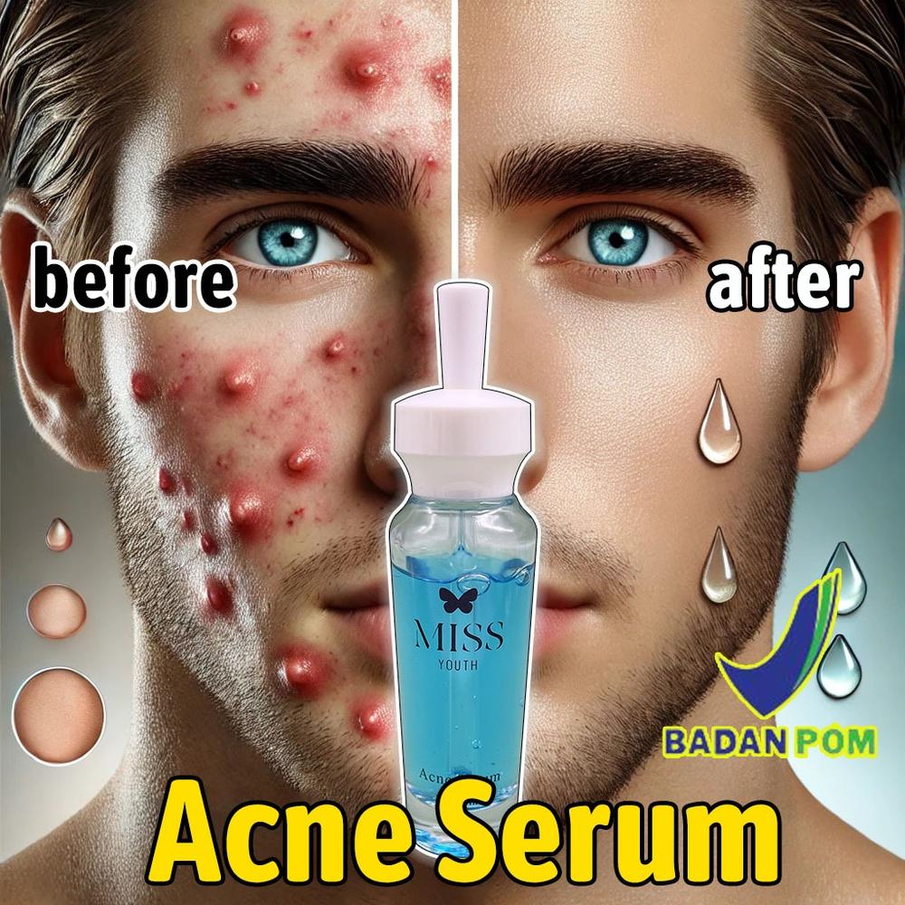 [BPOM] MISS YOUTH Serum jerawat pria wajah berminyak - Serum jerawat khusus pria dengan wajah berminyak. Mengurangi jerawat dan bruntusan, memberikan kulit bebas kilap dan terasa segar sepanjang hari.