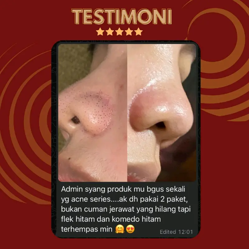 TERLARIS! ACNE TREATMENT SERIES Perawatan 5