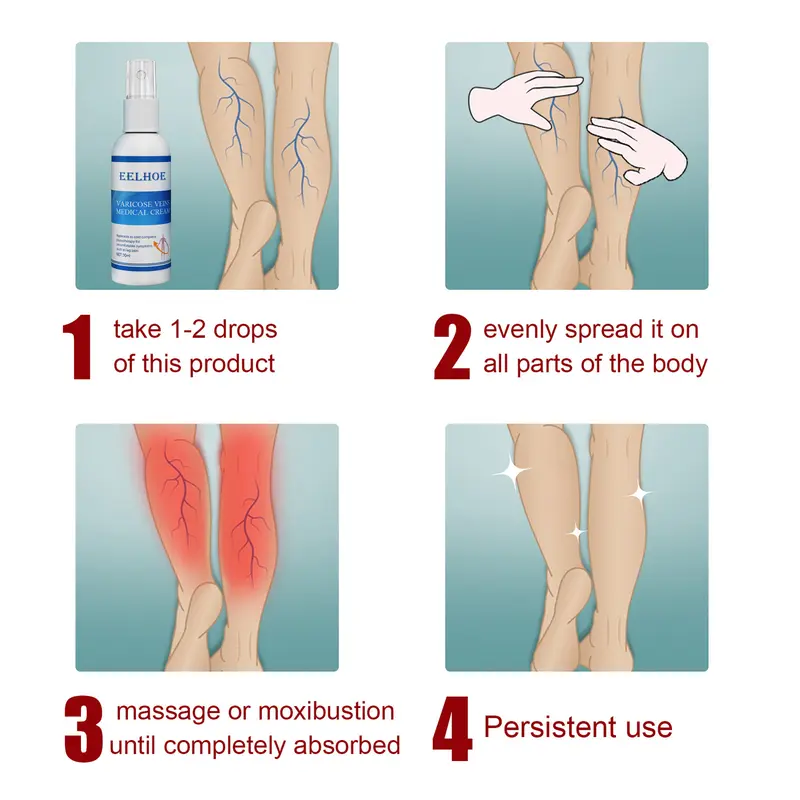 Intravenous massage spray for varicose veins relief and earthworm leg blood vessel bulge pain spray 5