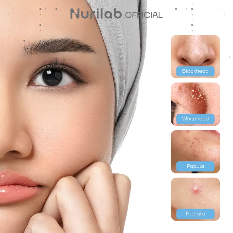 [TWIN PACK] Nurilab - Acne ConclearingTM Spot Drying Lotion 2.5g Obat Totol Jerawat 3