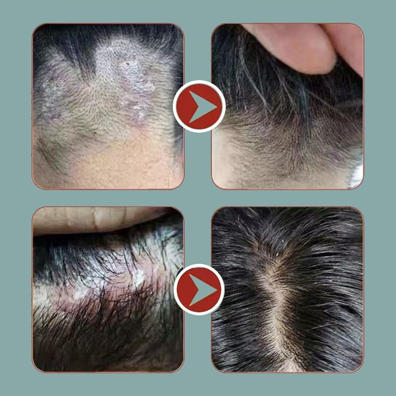 Shampo anti ketombe Penghilang ketombe berkerak dan gatal psoriasis kulit kepala Oil control Kulit kepala gatal Shampoo rambut 1