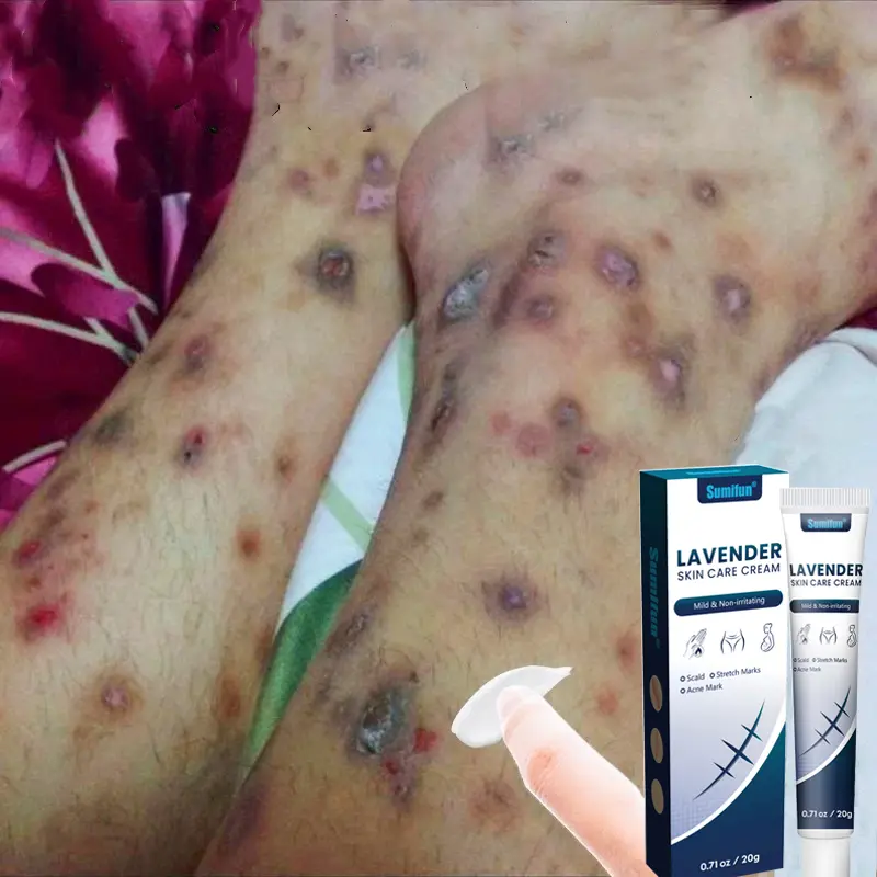 Penghilang bekas luka hitam koreng Penghilang bekas luka di kaki Penghilang Bekas cacar Bekas gigitan nyamuk Bekas lama Keloid