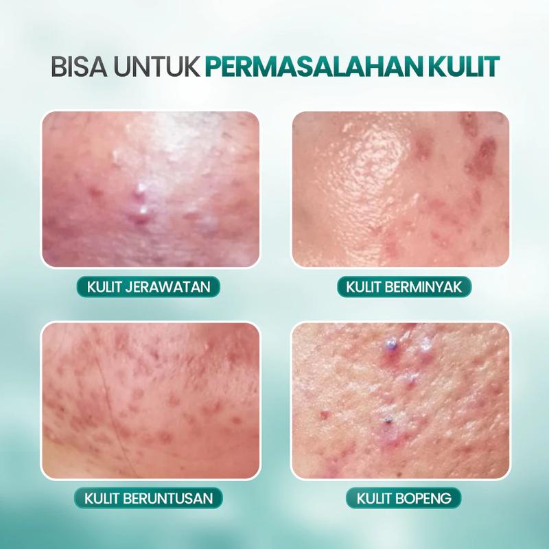 Daily Acne Moisturizer - Acneno isi 50gr | Memperbaiki Skin Barrier Kulit | Membantu Wajah Lebih Terhidrasi Kandungan Panthenol Aman Untuk Bumil & Busui | BPOM Original 5