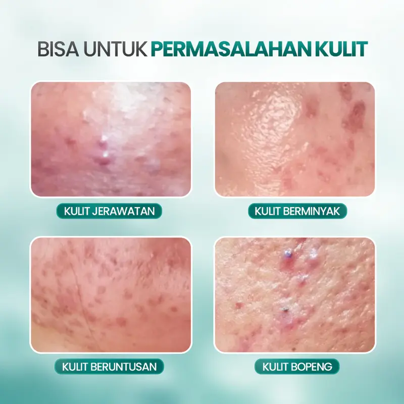 Daily Acne Moisturizer - Acneno isi 50gr | Memperbaiki Skin Barrier Kulit | Membantu Wajah Lebih Terhidrasi Kandungan Panthenol Aman Untuk Bumil & Busui | BPOM Original 4