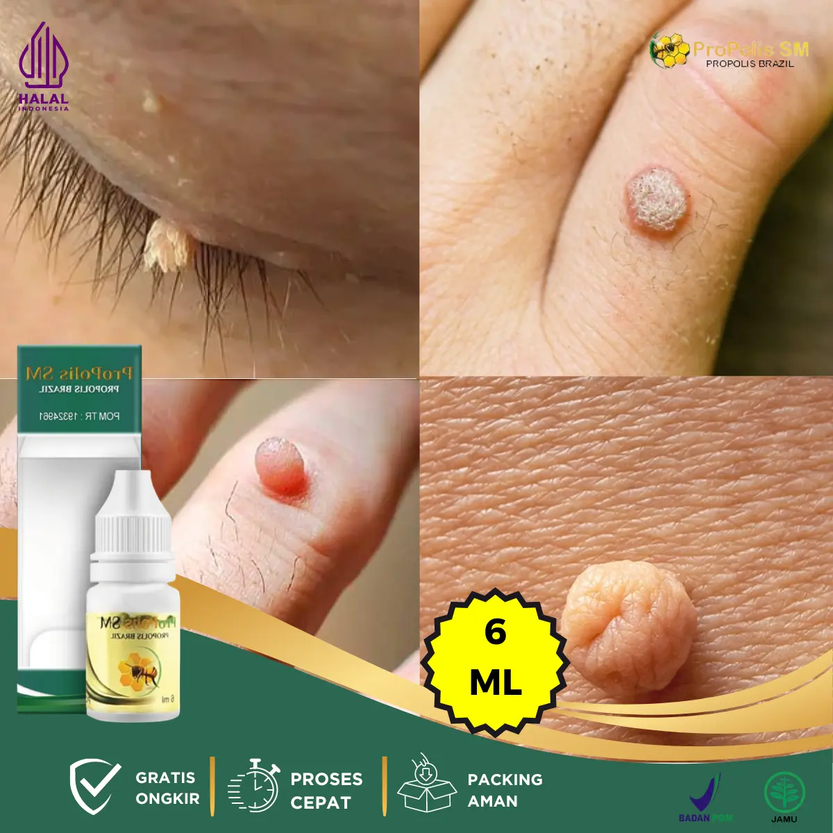 Papiloma Di Tangan, Kutil Dileher, Kutil Papiloma, Penghilang Skin Tag, Daging Tumbuh Dikulit, Oles Perontok Kutil