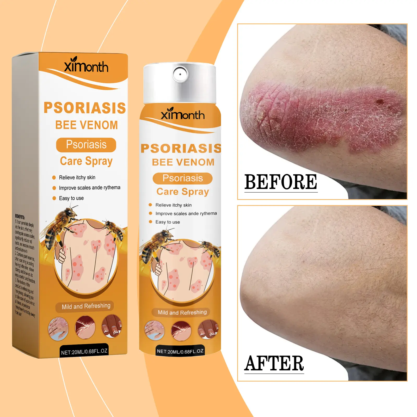 Bee Venom Psoriasis Spray Relieves Skin Itching Relieves Itching And Reduces Redness