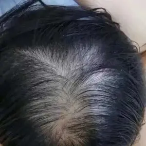 Minoxidil 5% Serum Penumbuh Rambut Penumbuh Rambut Botak Serum Rambut Rontok 30ml