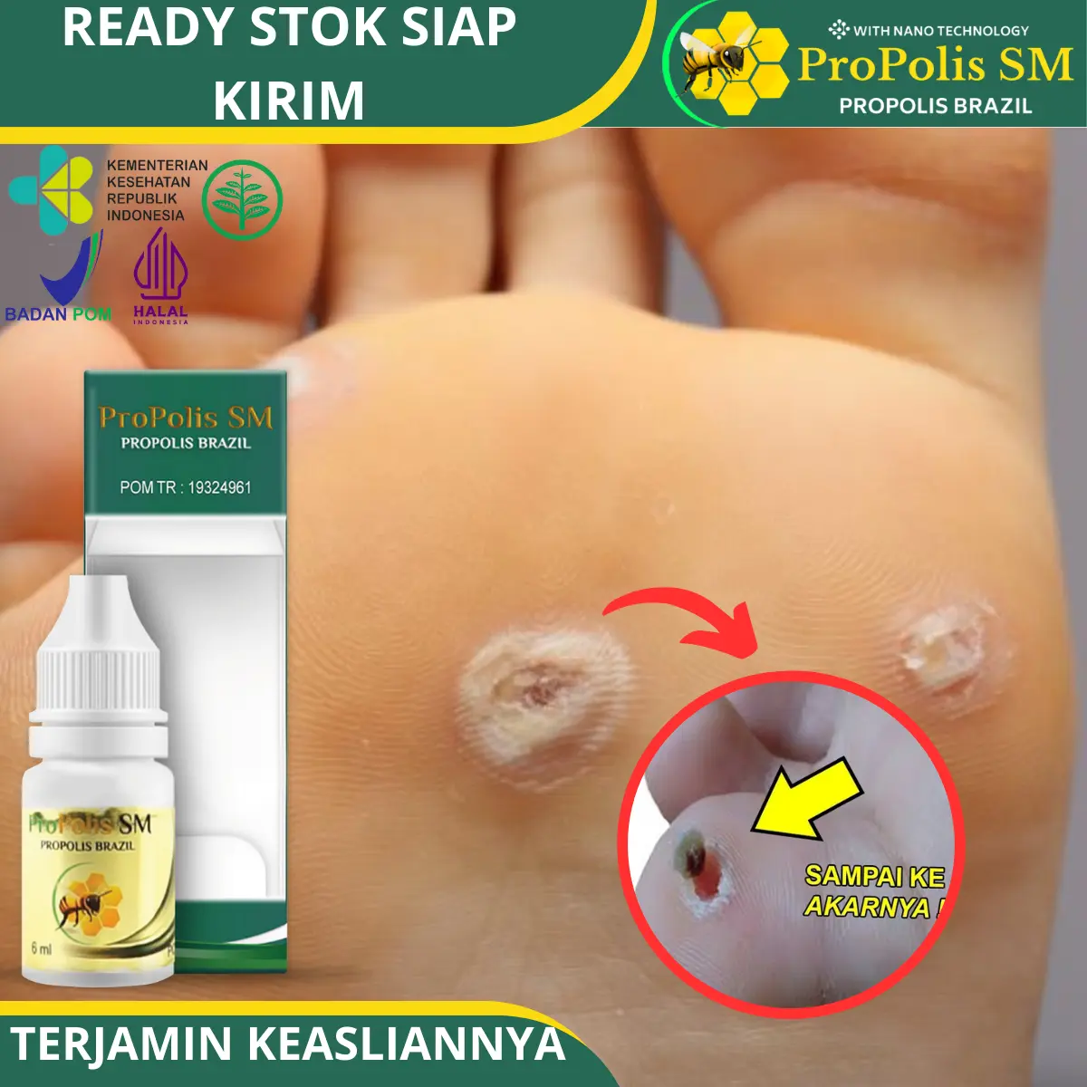 Penghilang clavus / Mata Ikan Di Kaki, Kutil, Skin Tag Dengan Propolis SM Brazilian