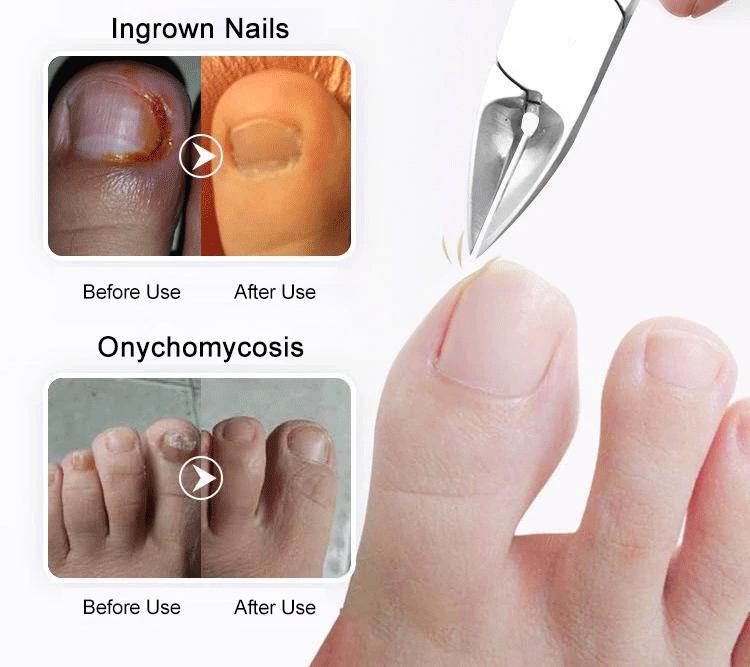 Product Introduction of Nail clippers for ingrown toenails single hawkbill clippers for gray fingernails nail fissures 10