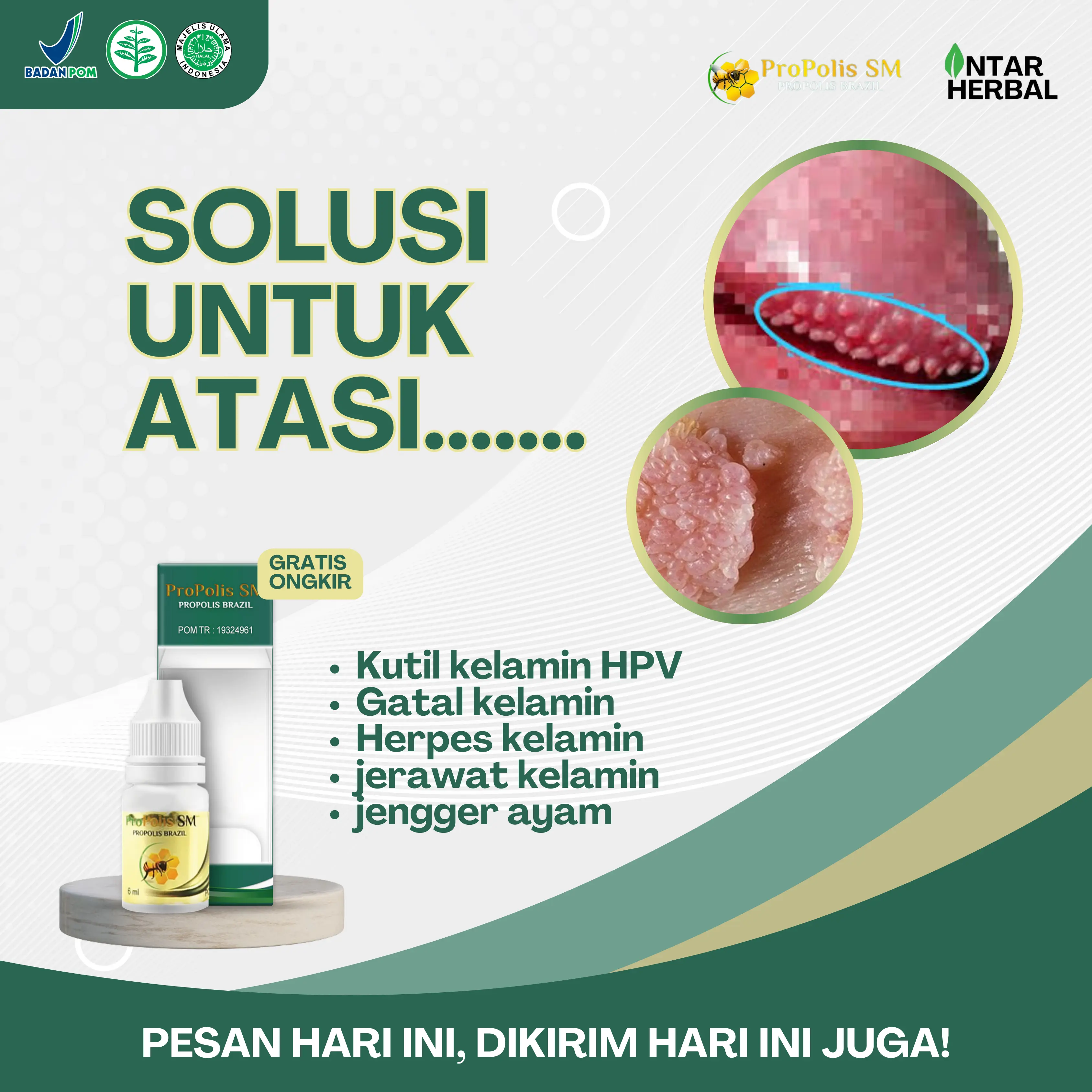 Propolis SM Salep Oles Kutil Kelamin Hpv, Gatal Kelamin, Bruntusan Di Kelamin, Herpes Kelamin, Menghilangkan Rasa Gatal Pada Kelamin Pria Dan Wanita Dengan Propolis SM