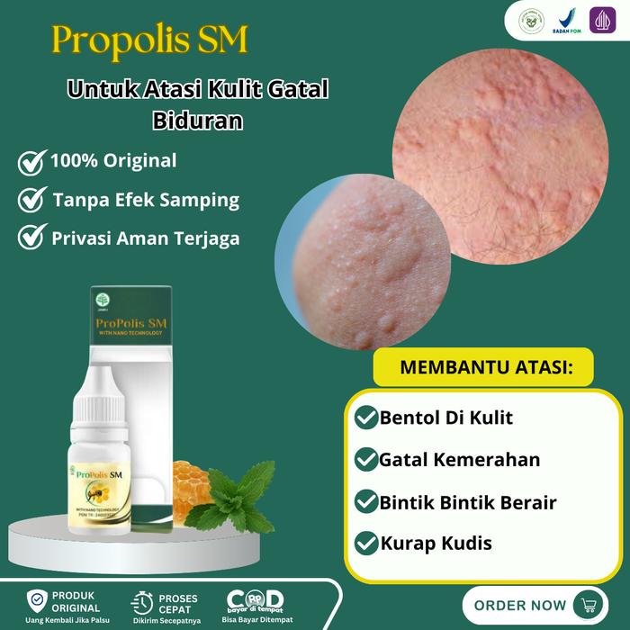 Jual Propolis SM - Untuk Penyakit Kulit, Gatal Seluruh Badan, Biduran ...