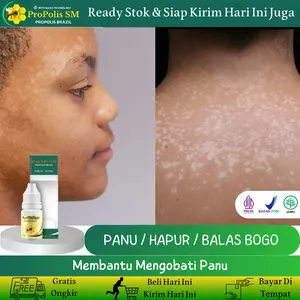 Panu, Hapur, Bintik bintik warna putih, balas bogo, panu anak  dewasa, Tinea Versicolor