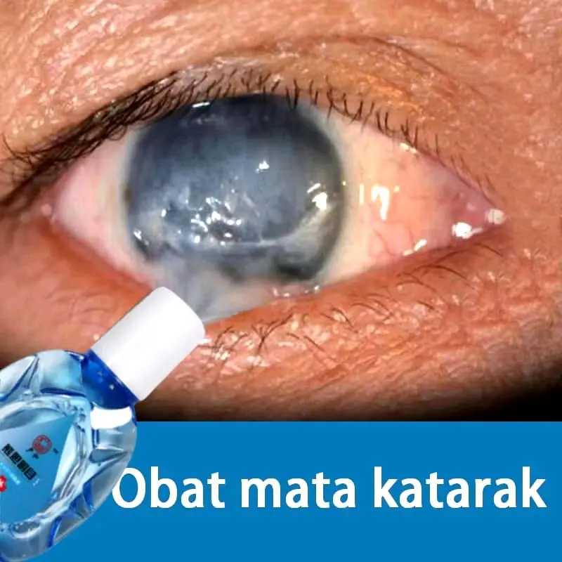 Tetes Mata Anak Dan Dewasa Tetes Mata Katarak Mata Kering Sakit Mata Darah Merah Ketegangan Mata Minus Katarak Berlemak Buram Kabur Bengkak 0