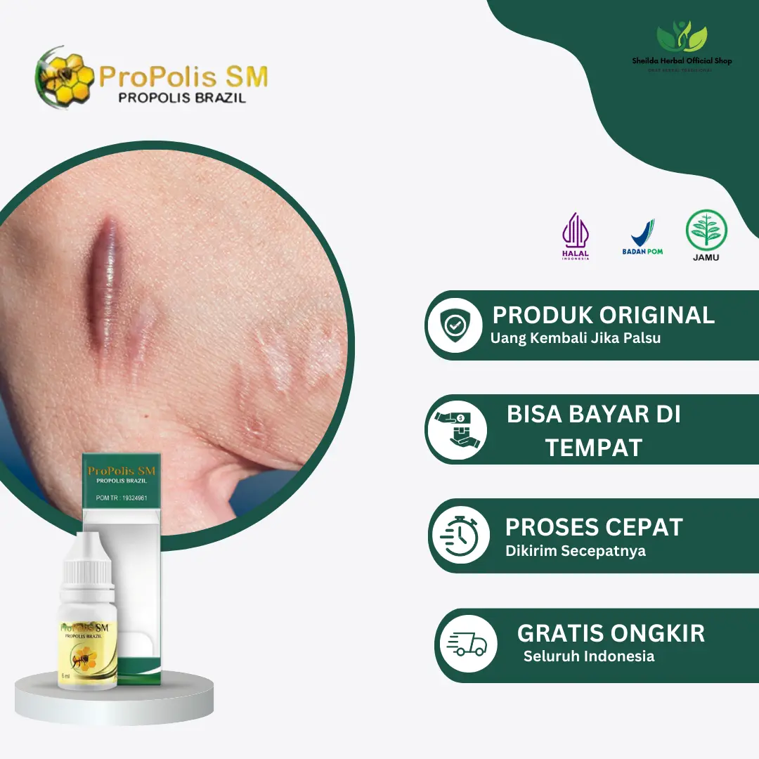 Propolis SM  Tetes Keloid, Daging Jadi, Keloid Berkerut, Keloid Akibat Bekas Luka,Pembersih Keloid Bekas Luka Gatal