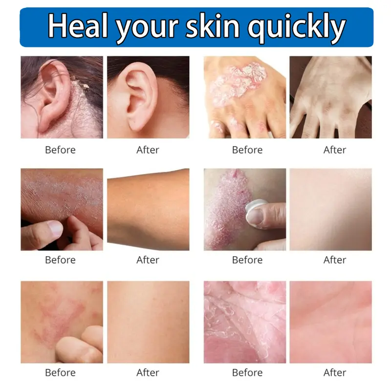 South Moon Salep Khusus Psoriasis - psoriasis ointment - Kurap Pada Kulit Kepala - Kutu Air - Kurap Pada Badan - Eksim - Infeksi Kulit - Obat Luar Mengatasi Gatal 20g Perawatan Tubuh Kering Pembersihan 3