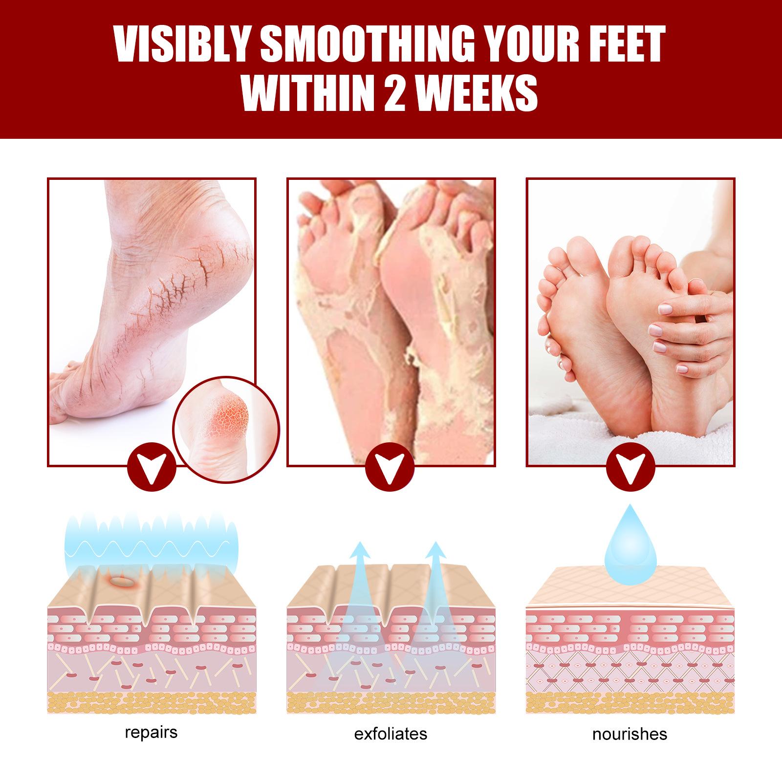 【COD】Exfoliating Foot Mask: Moisturizes and rejuvenates skin, removes calluses,exfoliates dead skin, hydrates and nourishes deep cleansing foot patch foot soak spa jiggersfootcare masker kaki kelupas koyo telapak kaki wormwoodfootpatch foot mask