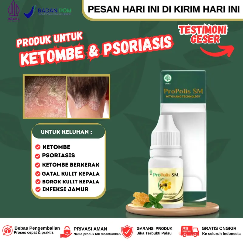 Propolis SM untuk Borok di Kepala, Kulit Kepala Berkerak dan Bersisik,  Gatal Kulit Kepala,  Ketombe ,  Jamur di Kepala,  Psoriasis Kulit Kepala 0