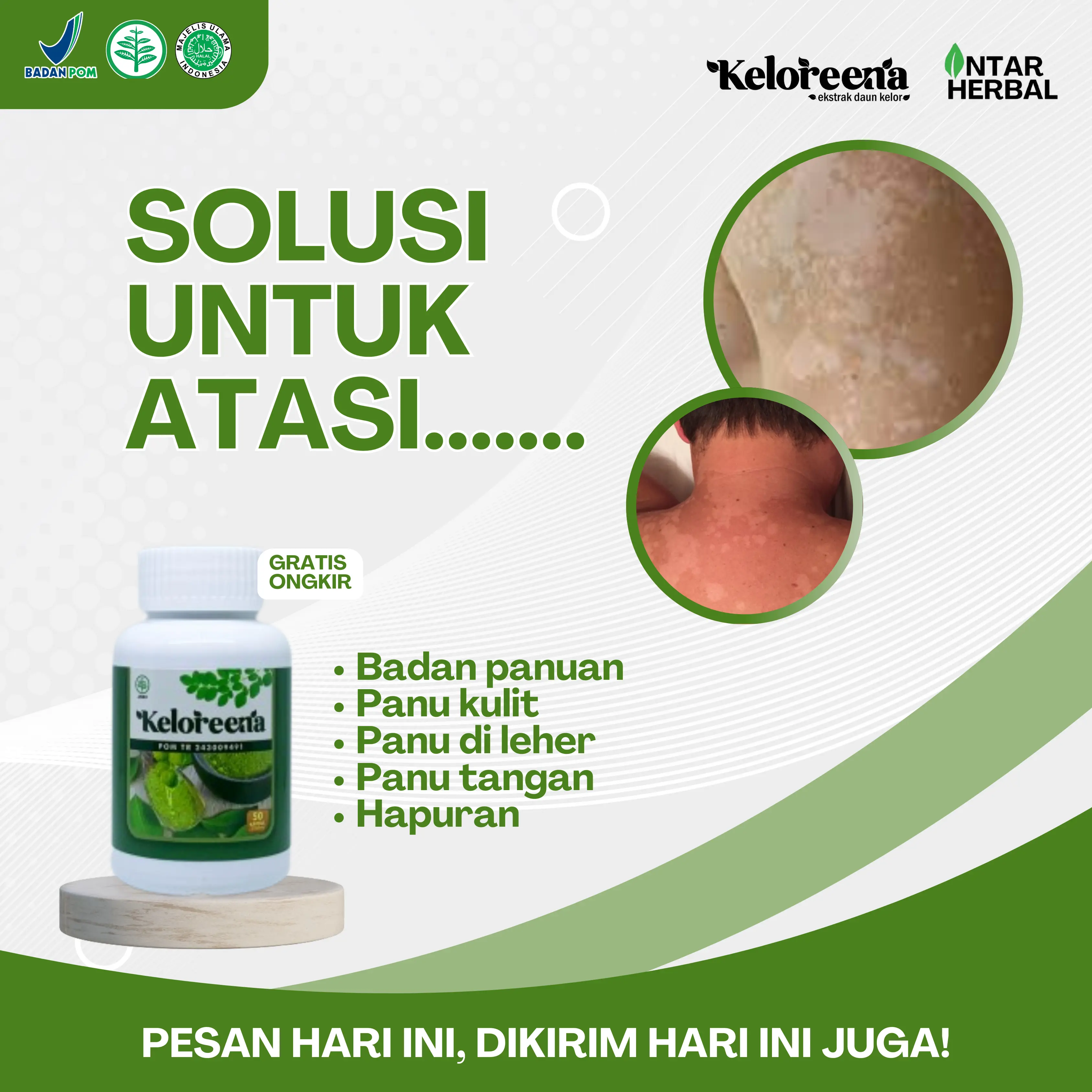 Keloreena Peghilang Panu Seluruh Badan, Panu Di Leher Belakang, Panu Tubuh, Panu Di Badan, Panu Di Dada, Panu Di Tangan, Hapur Kulit, Hapuran, Panu Punggung, Jamur Kulit Wajah