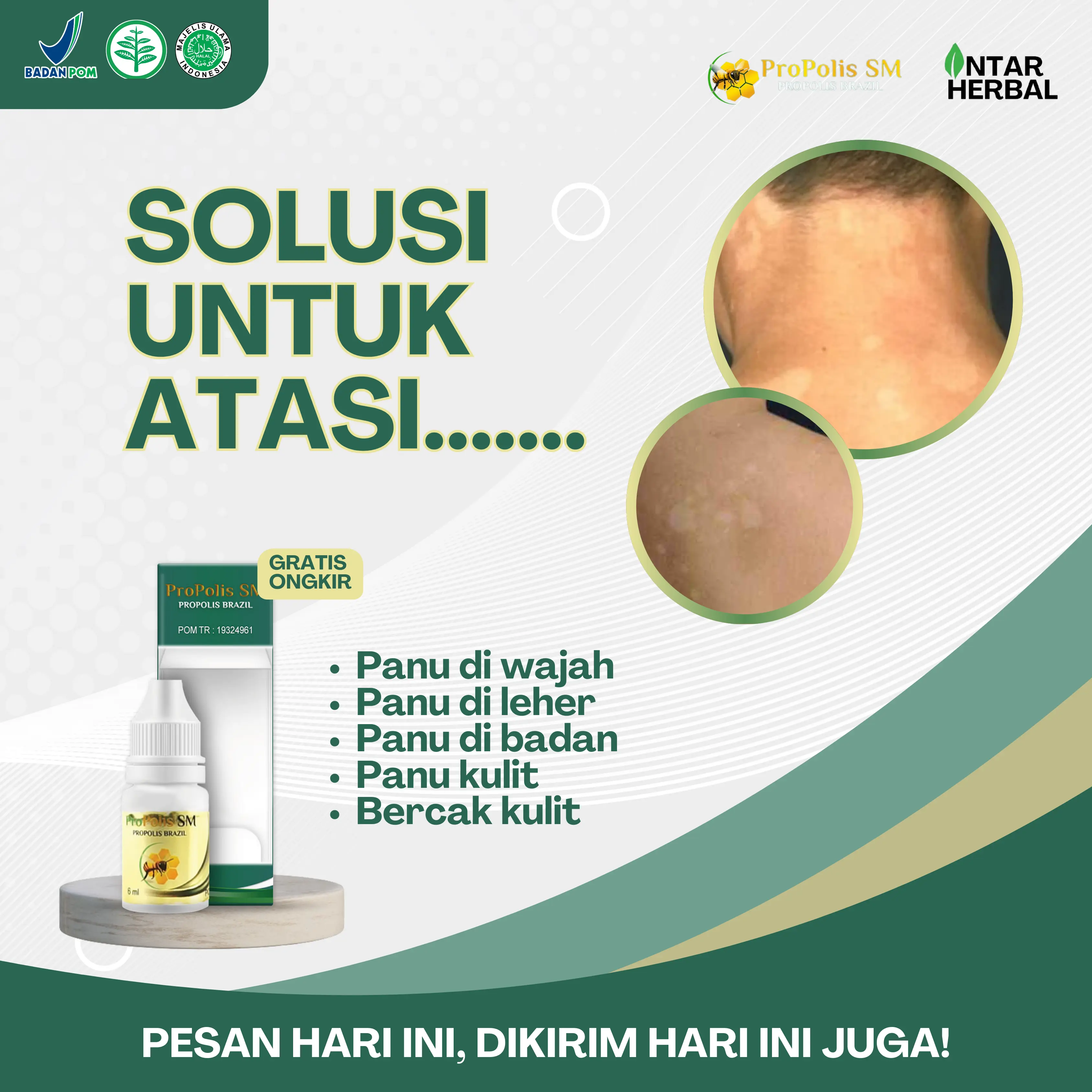 Propolis SM Panu, Jamur Kulit, Penghilang Panu Menyebar Di Seluruh Tubuh, Panu Di Badan, Hapuran, Panu Di Leher, Panu Di Punggung, Bercak Putih Di Kulit, Pembersih Panu