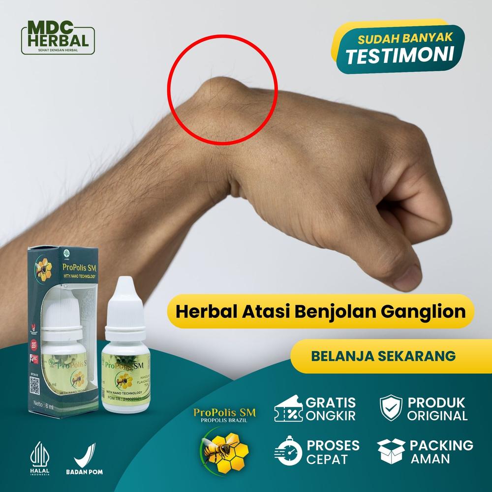 Penghancur Benjolan Ganglion, Herbal Benjolan Ganglion, Benjolan Lipoma, Benjolan Di Tangan, Kista Ganglion, Tumor Jinak, Benjolan Keras Berisi Cairan, Benjolan Lipoma, Benjolan Di Pergelangan Sendi -