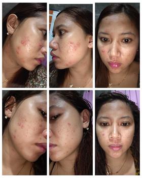 Product Review of 【Hoki Bundle】NPURE Paket Acne Face Toner Cica 150ml + Power Clear Micellar 300ml / Clear Pad 40pads + Power Clear Micellar 300ml / Melembabkan kulit / Mencerahkan / kulit berjerawat/ sensitif / Membersihkan debu polusi Kotoran / Exfoliating Wajah from 아** K**I 1