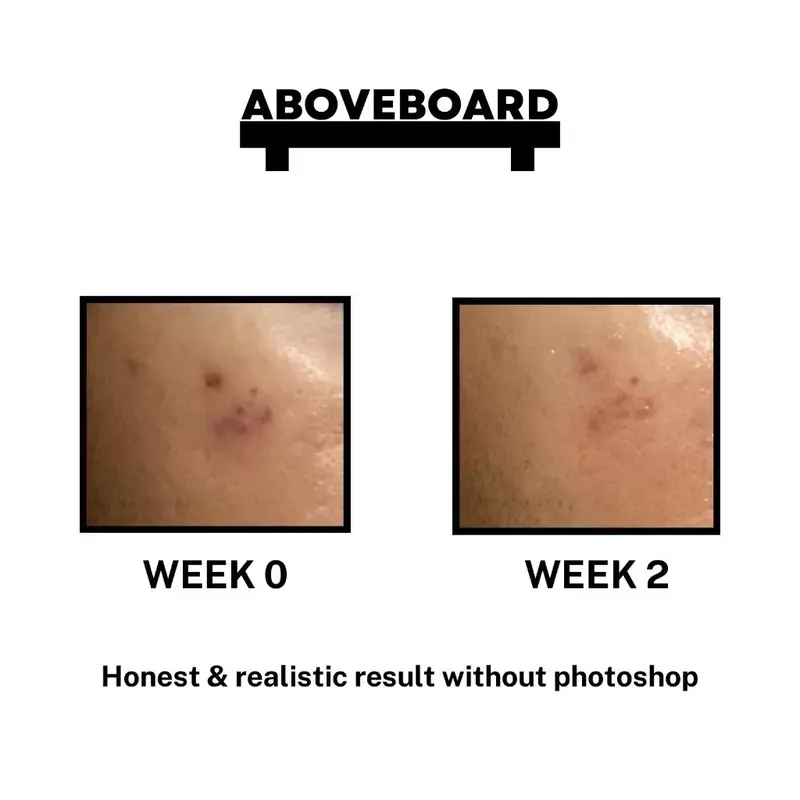 Serum Aboveboard untuk bekas jerawat PIH/PIE (100% original) 2