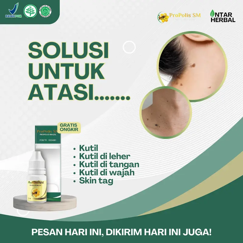 Propolis SM Kutil Papiloma, Perontok Daging Tumbuh, Penghilang Kutil Di Leher, Kutil Di Tangan, Kutil Di Kaki, Kutil Di Wajah, Menghilangkan Daging Jadi Skin Tag 0