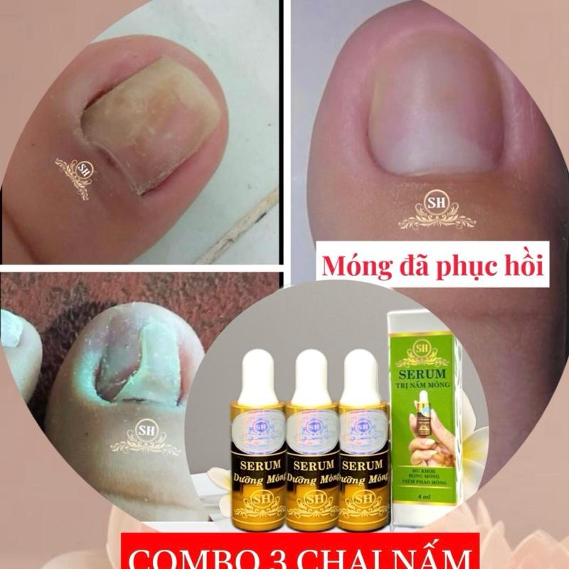 Serum Nấm Móng Dùng Cho Móng Tay Và Chân 03 lọ nấm móng