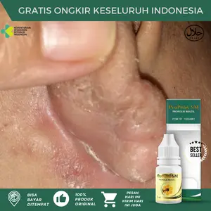 Telinga Berkerak, Salep Psoriasis Kulit,  Borok Di Telinga, Gatal Bernanah Di Telinga, Kulit Bersisik, Budug Di Telinga, Infeksi Telinga