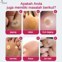Gambar Plester Mata Ikan Paling Ampuh Obat Mata Ikan Kaki Penghilang Mata Ikan Di Tangan Foot Corn Removal Plester Stiker - 1PCS dari Polkadope Indonesia Kota Tangerang 4 Tokopedia
