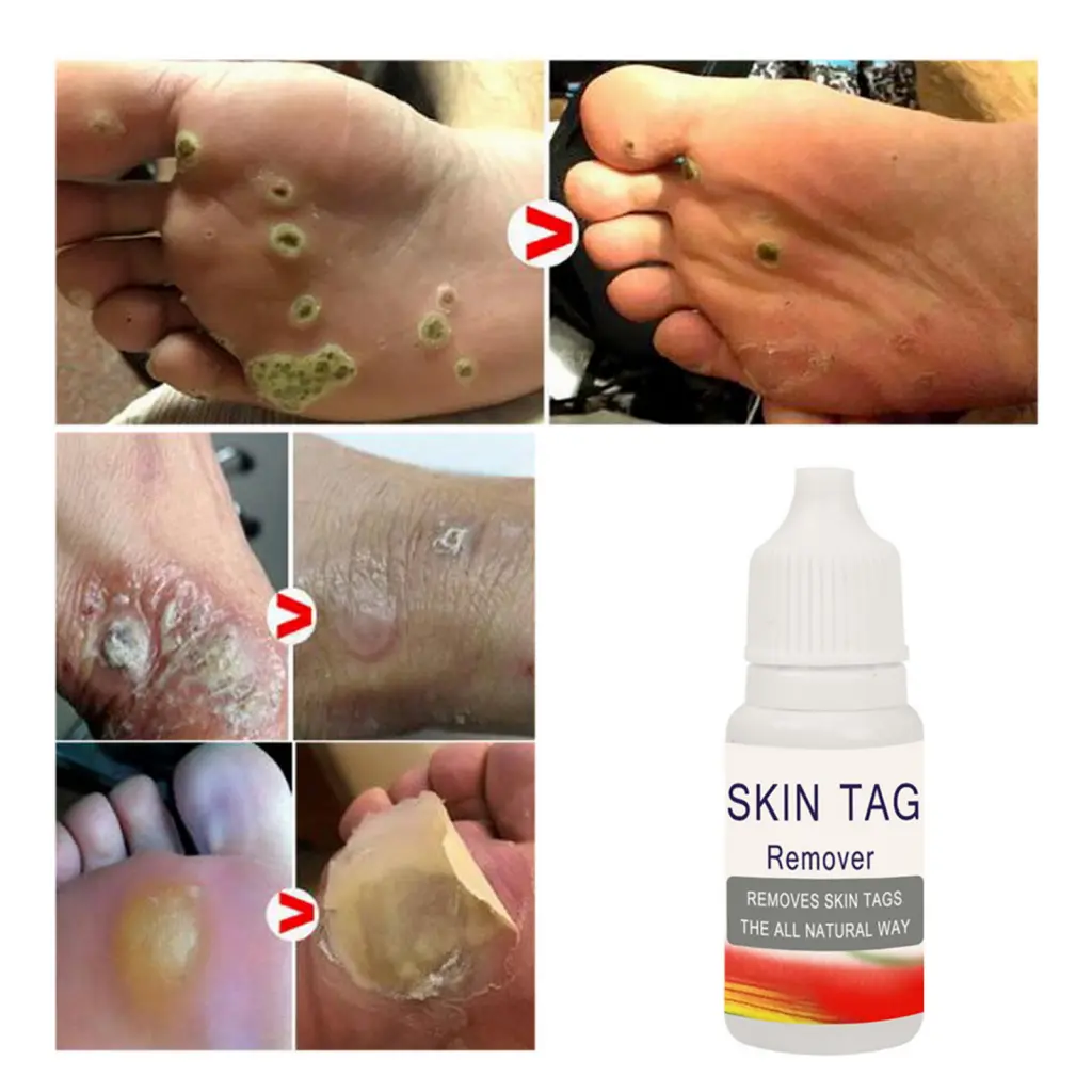 Chất lỏng loại bỏ mụn cóc, Xadnywa, Dễ dàng áp dụng, Kích thước nhỏ, Chất tẩy mụn cóc, Tẩy thẻ, Dụng cụ sửa chữa Corn sinh dục, Chất lỏng tự nhiên, Thích hợp cho người lớn, Nhẹ nhàng cho da