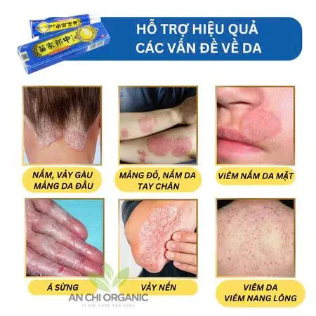 ( COMBO 10 TUÝP ) Kem Bôi Viêm Da Cơ Địa Dứt Điểm Lác Đồng Tiền, Hắc Lào, Á Sừng, Côn Trùng Đốt Hiệu Quả - BÀ LÃO XANH 4