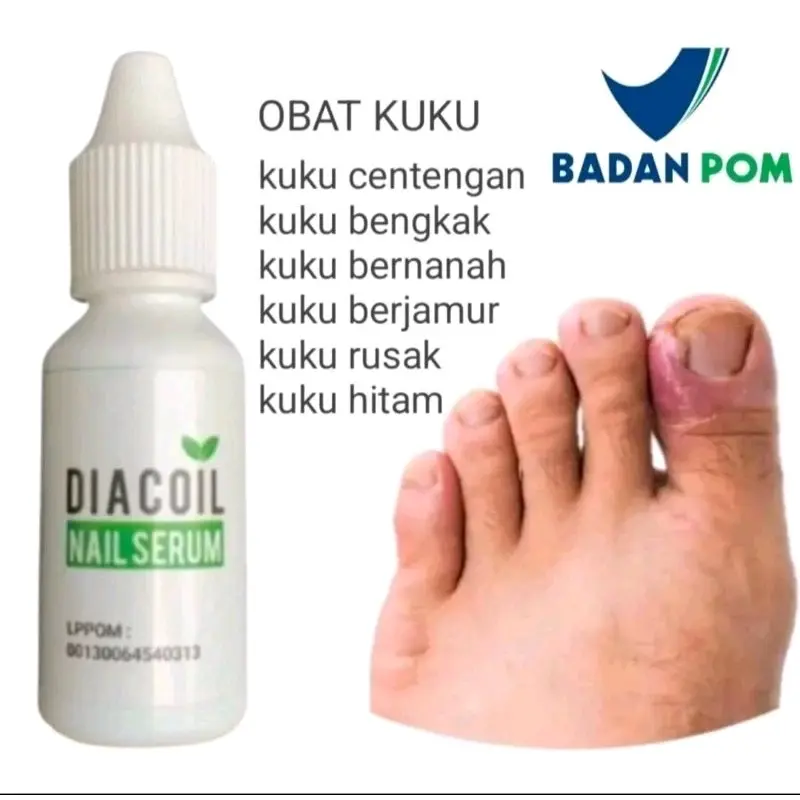 GARANSI ORIGINAL OBAT KUKU ATASI CANTENGAN JAMUR KUKU RUSAK DAN BENGKAK AMPUH 1
