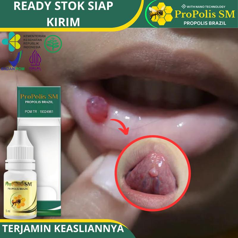 Propolis SM - Untuk Penghilang Kelenjar Mucocele / Ranula Benjolan di Bawah Lidah, Di Mulut / Bibir 1