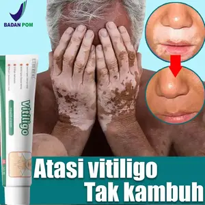 Obat salep kulit vitiligo 20g Skincare Obat vitiligo paling ampuh Salep vitiligo Menghilangkan vitiligo